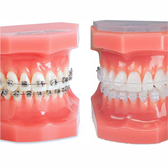 Odonto Integral - Ortodoncia - Brackets transparentes vs Brackets de metal