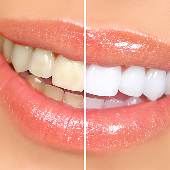 Odonto Integral - Cosmetica dental - Cuando te blanquean los dientes