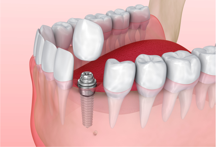 Odonto Integral - Implantes dentales - ¿Por qué es importante reemplazar los dientes perdidos?